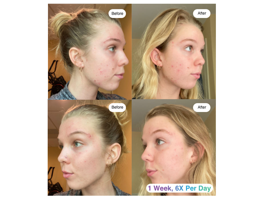 Before and after use of ClearSynergy left and right side of young woman face