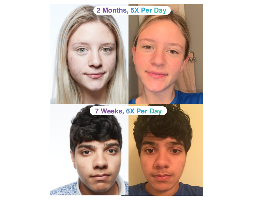 Before and after ClearSynergy use face of young woman and young man